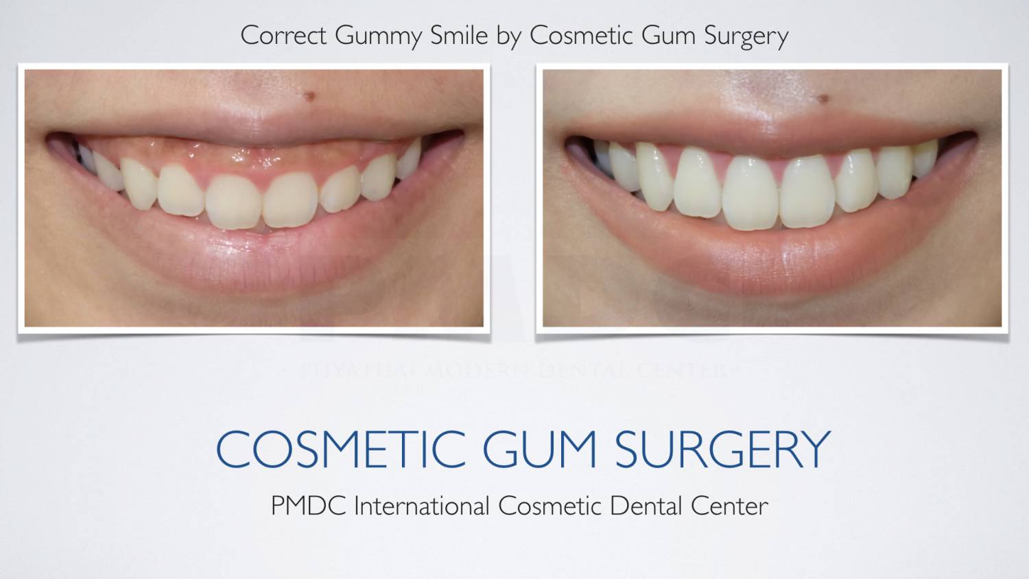 Cosmetic Gum Surgery | PMDC Dental